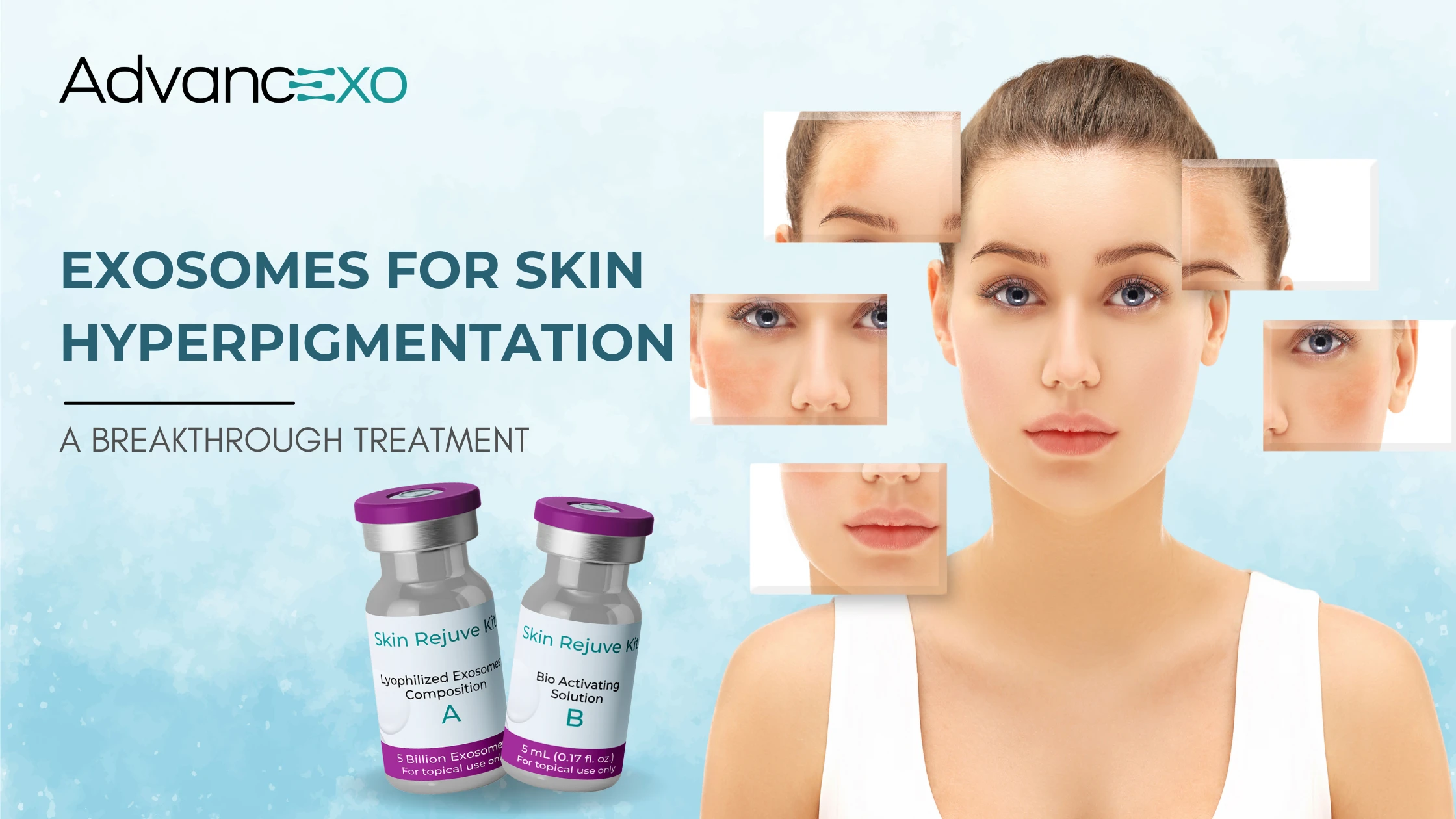 You are currently viewing Exosomes for Skin Hyperpigmentation: A Breakthrough Treatment