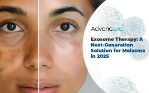 Read more about the article Exosome Therapy: A Next-Generation Solution for Melasma in 2025