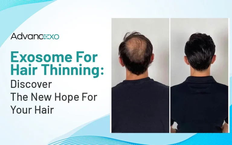 Read more about the article Exosome for Hair Thinning: Discover the New Hope for Your Hair