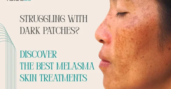 Struggling with Dark Patches? Discover the Best Melasma Skin Treatments