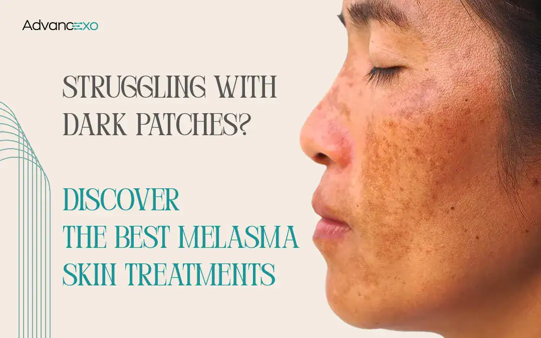 You are currently viewing Struggling with Dark Patches? Discover the Best Melasma Skin Treatments