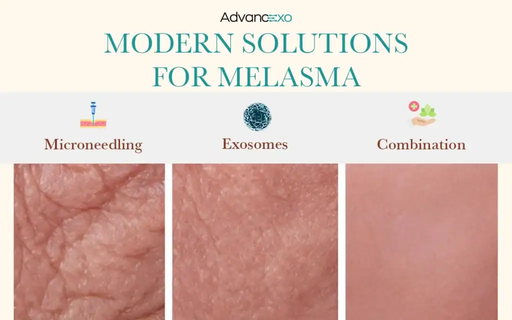 Modern-Best-Treatment-for-Melasma