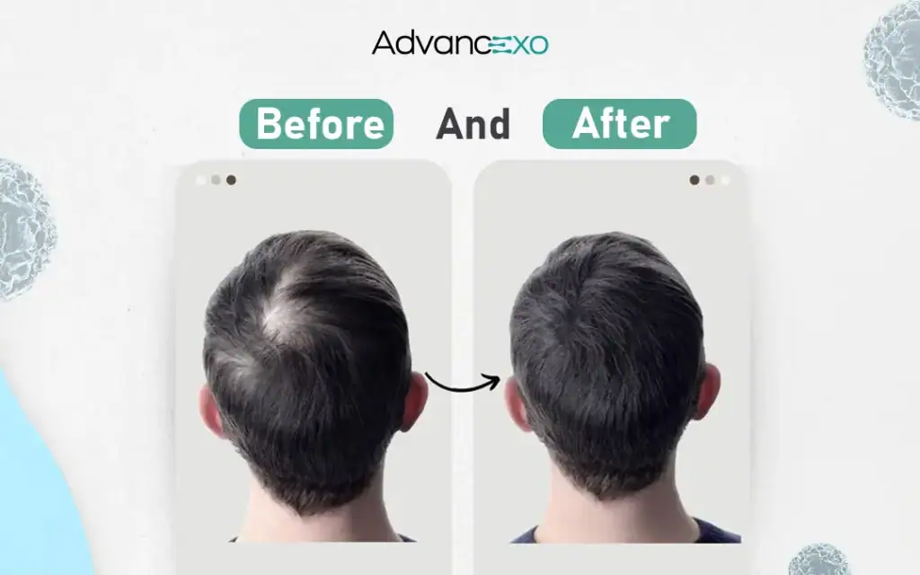 Exosomes-for-Hair-Loss-Before-and-After​