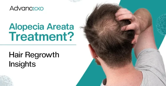 Can Exosomes Help Restore Hair Growth in Alopecia Areata?