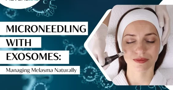 Microneedling With Exosomes: A New Approach for Melasma