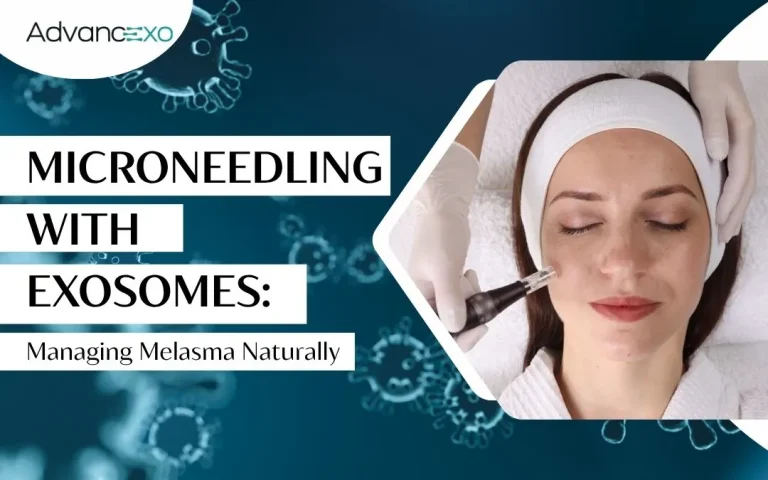 Read more about the article Microneedling With Exosomes: A New Approach for Melasma